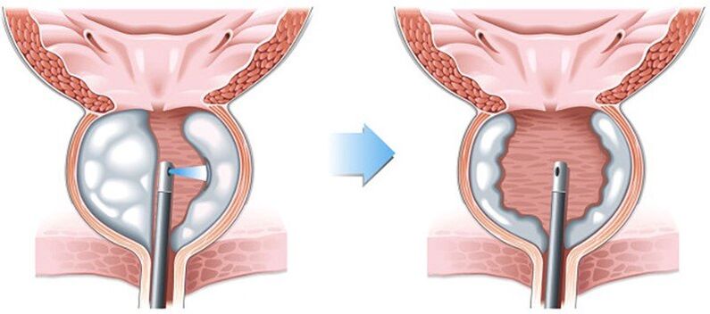 Prostatitida operace