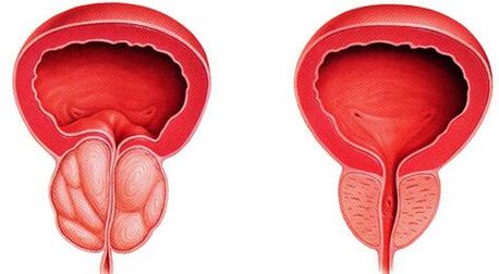 Rozdíl nemocné a zdravé prostaty